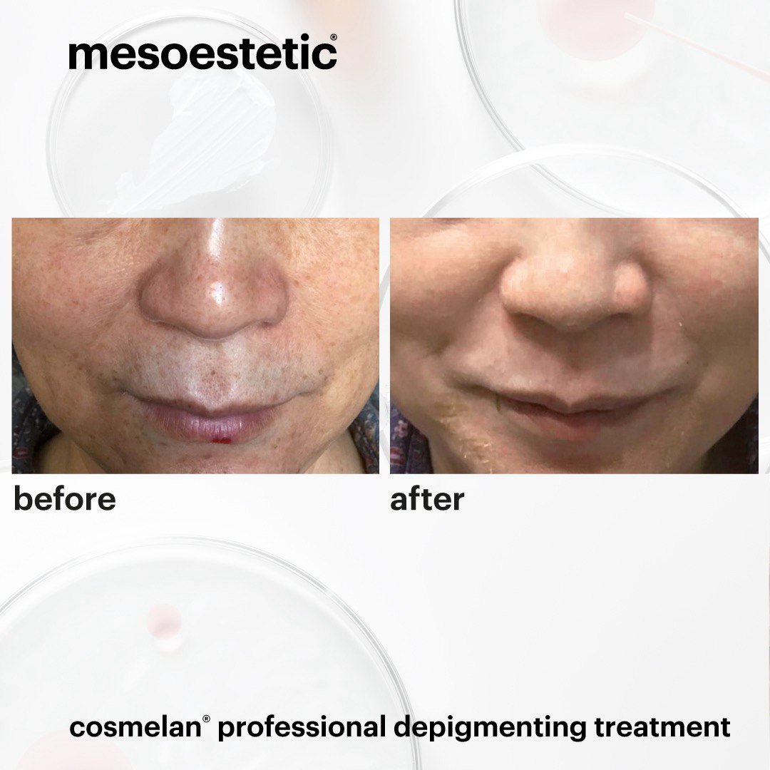 Cosmelan Peel for Radiant Skin | London Aesthetics Clinic