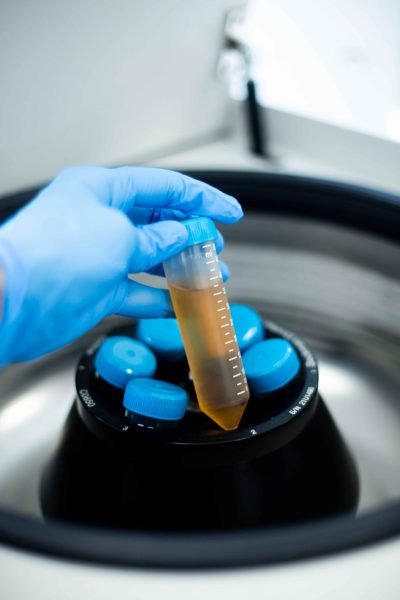 PRP Under-Eye Treatment ​