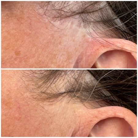 Scar Camouflage london